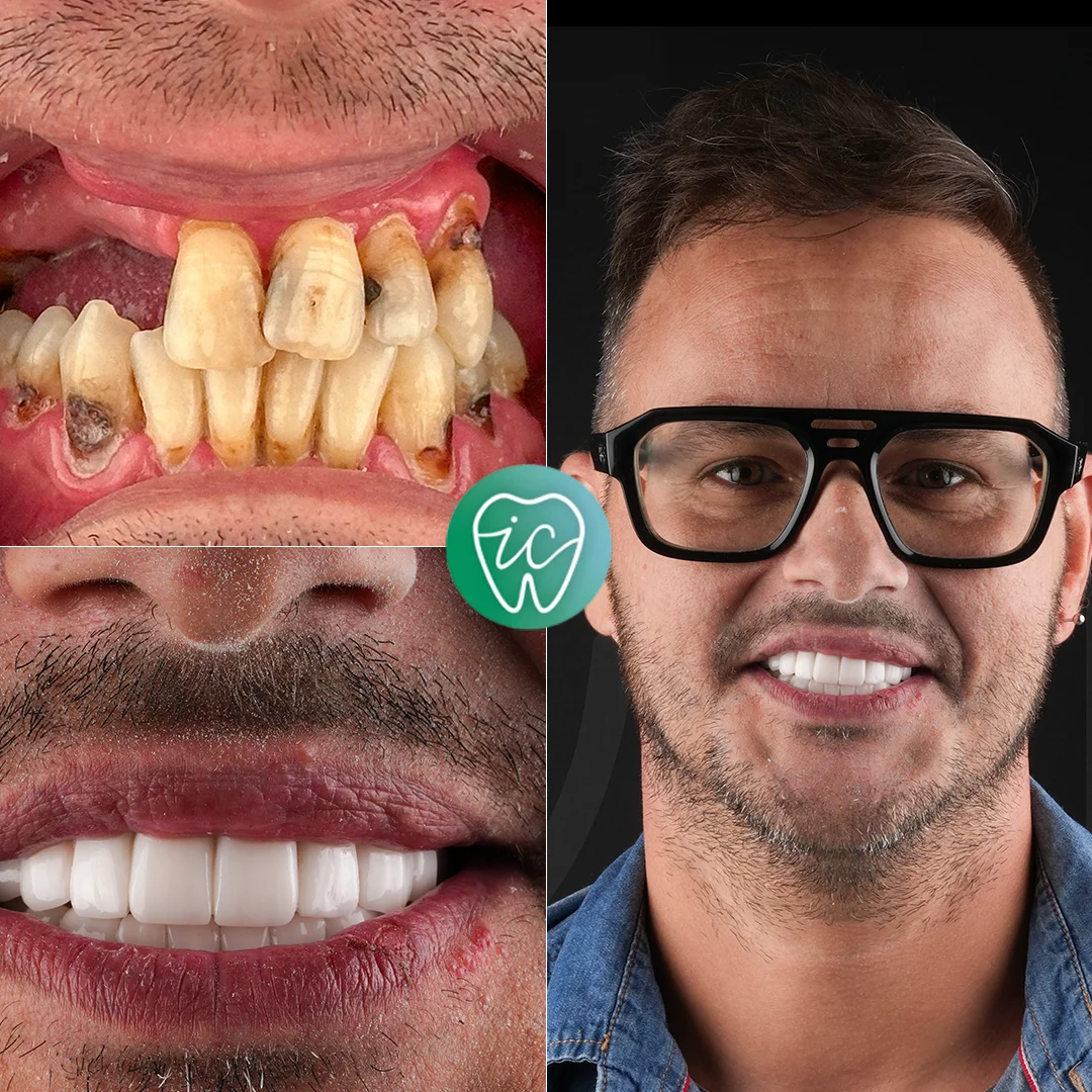 Treatment before and after